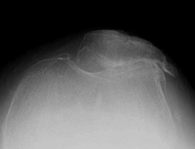 Patella OA Tilt